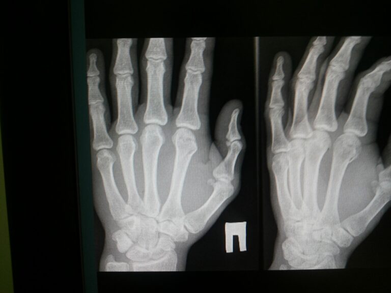Vegan and vegetarian, more prone to bone fractures: study