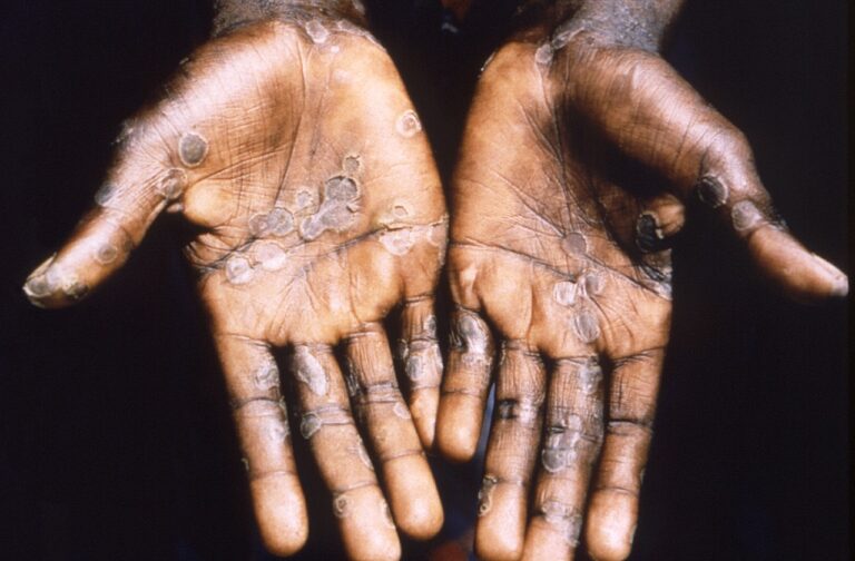 SF outpaces pace of response to "monkeypox" outbreak