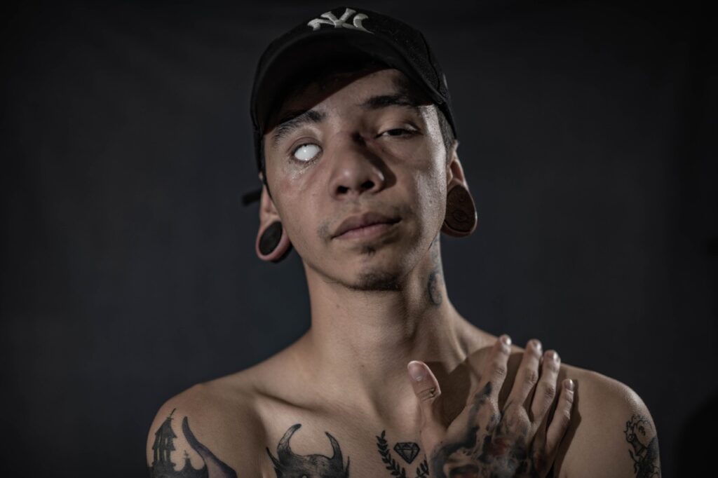 丹尼尔-亚历杭德罗-海梅斯（Daniel Alejandro Jaimes）是2021年5月ESMAD袭击的受害者，他在袭击中失去了右眼，10颗牙齿碎片，上颚和鼻子脱落。照片：Manuel Ortiz P360P