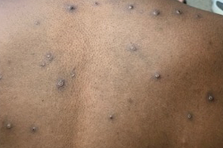 New York declares a State of Emergency due to smallpox