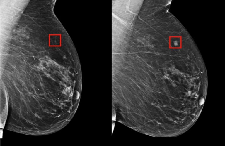 Inteligencia Artificial ayuda a predecir cáncer de mama hasta con 5 años de anticipación