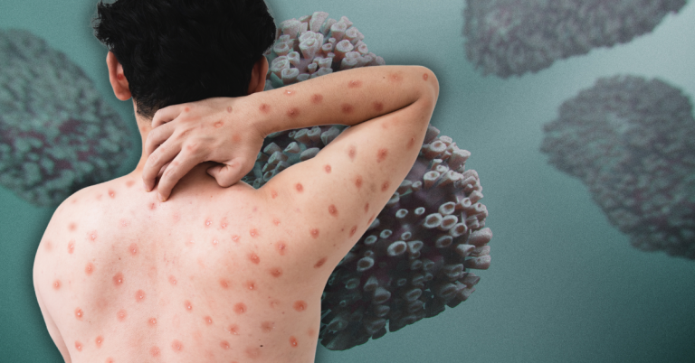 Autoridades de salud del condado de San Mateo responden ante nueva cepa de Mpox